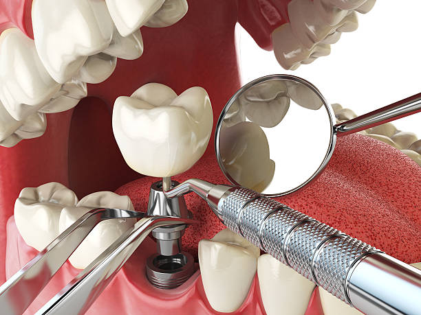 Best Knocked-Out Tooth Emergency  in Lmerton, PA
